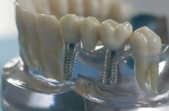 İmplant ağızda kemik erimesine sebep oluyor